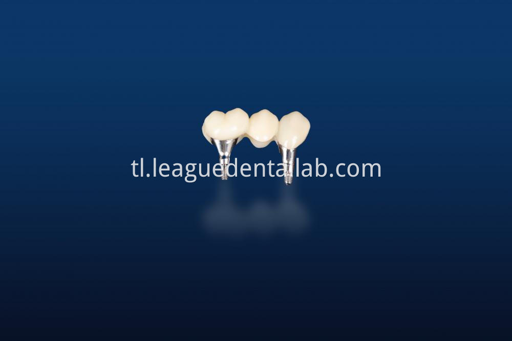 Dental Implant Crown, Dental Implant Zirconia crown,Dental Implant Emax crown,Dental Implant Bridge